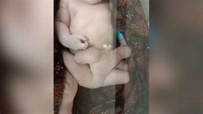 Viral! se-Indonesia! Wanita Ini Melahirkan Bayi Berkaki 6, Setelah Dicek Dokter, Ternyata